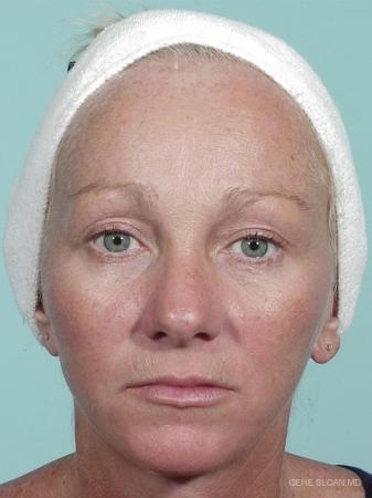 Facelift: Patient 4 - After Image 1