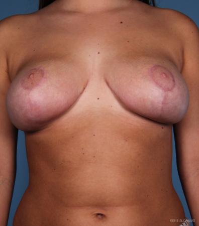 Breast Reduction: Patient 2 - After Image 1