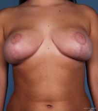 Breast Reduction: Patient 2 - After Image