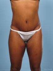 Abdominoplasty: Patient 2 - After Image