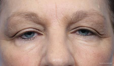 Blepharoplasty: Patient 7 - Before Image 1