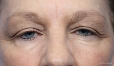 Blepharoplasty: Patient 7 - Before Image