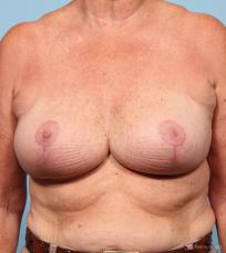 Breast Reduction: Patient 1 - After Image