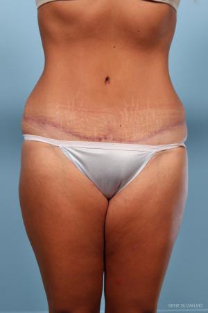 Abdominoplasty: Patient 1 - After Image 1