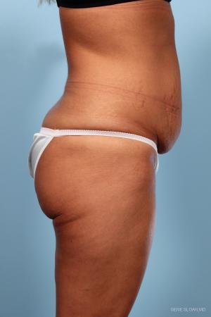Abdominoplasty: Patient 1 - Before and After Image 2