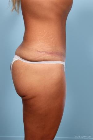 Abdominoplasty: Patient 1 - After Image 2
