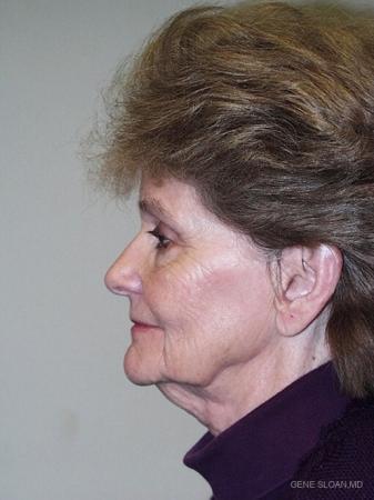 Facelift: Patient 3 - Before and After Image 2