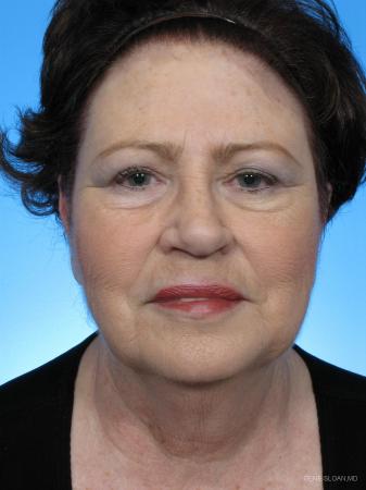 Facelift: Patient 1 - Before Image 1