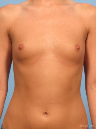 Breast Augmentation: Patient 14 - Before Image 1
