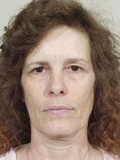 Facelift: Patient 5 - Before Image