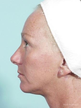 Facelift: Patient 4 - After Image 2