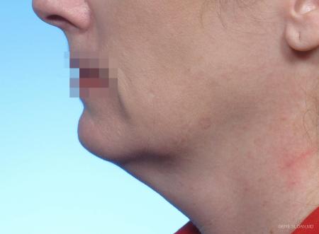 Neck Lift: Patient 2 - Before Image 1