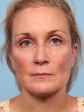 Facelift: Patient 7 - After Image