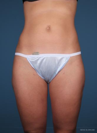Liposuction: Patient 1 - After Image 1