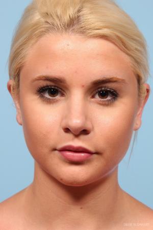 Rhinoplasty: Patient 8 - After Image 1