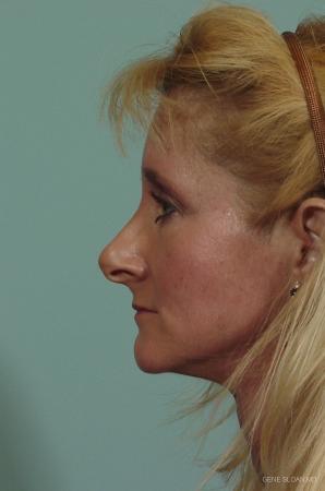 Rhinoplasty: Patient 2 - Before and After Image 2
