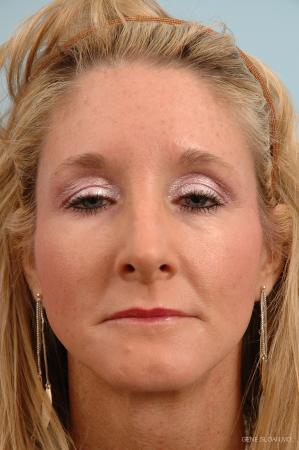 Rhinoplasty: Patient 2 - After Image 1