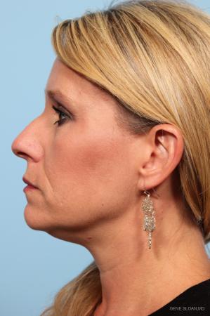 Rhinoplasty: Patient 3 - Before and After Image 2