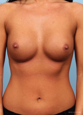 Breast Augmentation: Patient 6 - After Image 1