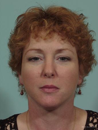Neck Lift: Patient 1 - After Image 1