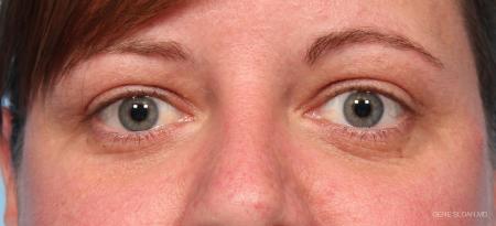 Blepharoplasty: Patient 5 - After Image 1