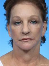 Facelift: Patient 2 - After Image