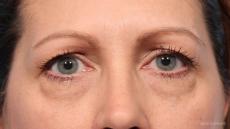 Blepharoplasty: Patient 9 - Before Image
