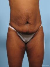 Abdominoplasty: Patient 2 - Before Image