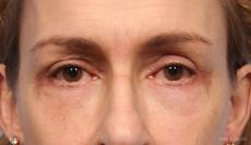 Blepharoplasty: Patient 8 - After Image