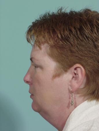 Neck Lift: Patient 1 - Before and After Image 2