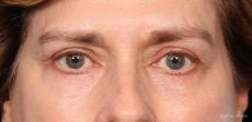 Blepharoplasty: Patient 1 - After Image