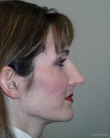 Rhinoplasty: Patient 1 - Before and After Image 2