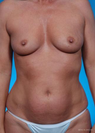 Mommy Makeover: Patient 1 - Before Image 1