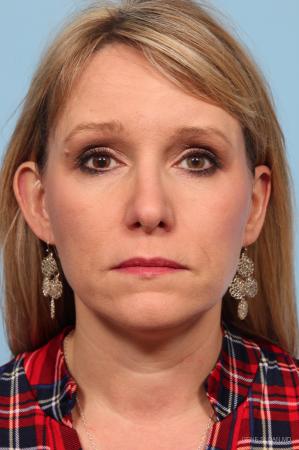 Rhinoplasty: Patient 3 - After Image 1