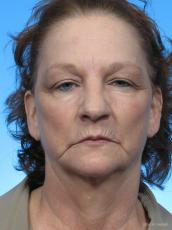 Facelift: Patient 2 - Before Image