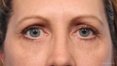 Blepharoplasty: Patient 9 - After Image