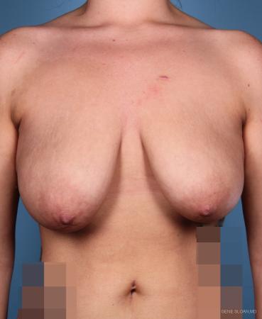 Breast Lift: Patient 1 - Before Image 1