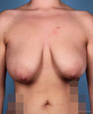Breast Lift: Patient 1 - Before Image