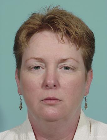Neck Lift: Patient 1 - Before Image 1