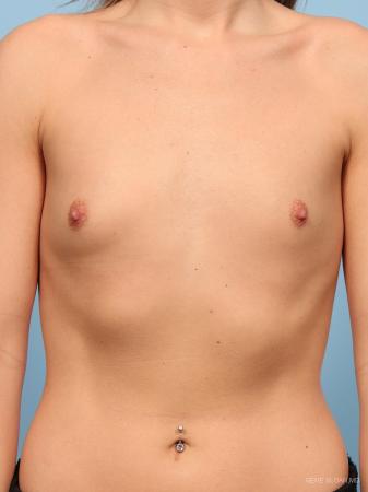 Breast Augmentation: Patient 15 - Before Image 1