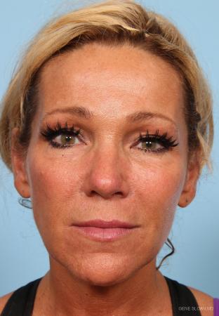 Fat Transfer - Face: Patient 1 - After Image 1