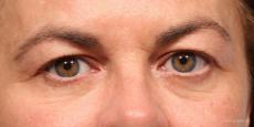Blepharoplasty: Patient 4 - Before Image