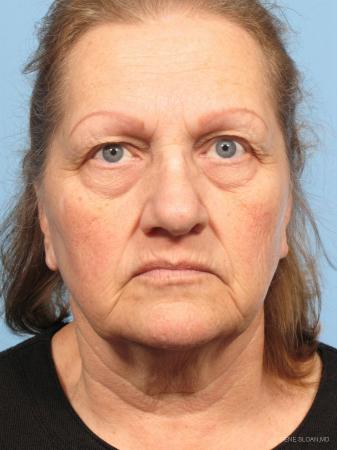 Facelift: Patient 6 - Before Image 1