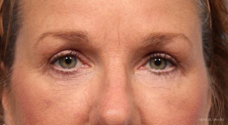 Blepharoplasty: Patient 6 - After Image 1