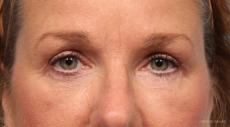 Blepharoplasty: Patient 6 - After Image