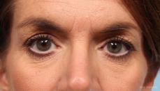 Blepharoplasty: Patient 2 - Before Image