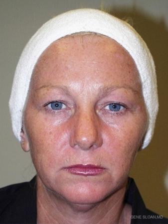 Facelift: Patient 4 - Before Image 1