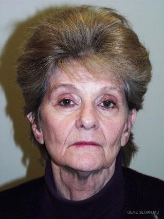 Facelift: Patient 3 - Before Image 1