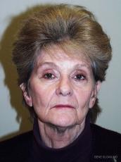 Facelift: Patient 3 - Before Image