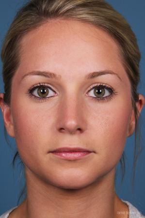 Rhinoplasty: Patient 7 - After Image 1